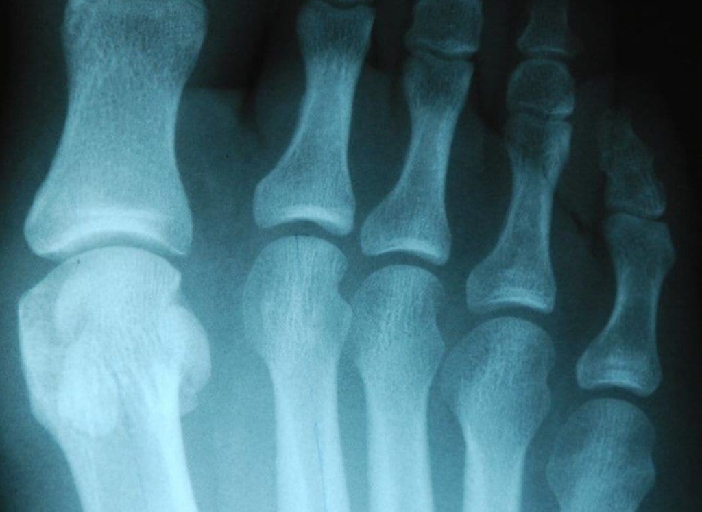 World Cup Special Edition: Soccer Player With A Sesamoid Injury