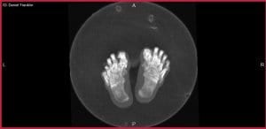 pedCAT weight bearing CT ballet