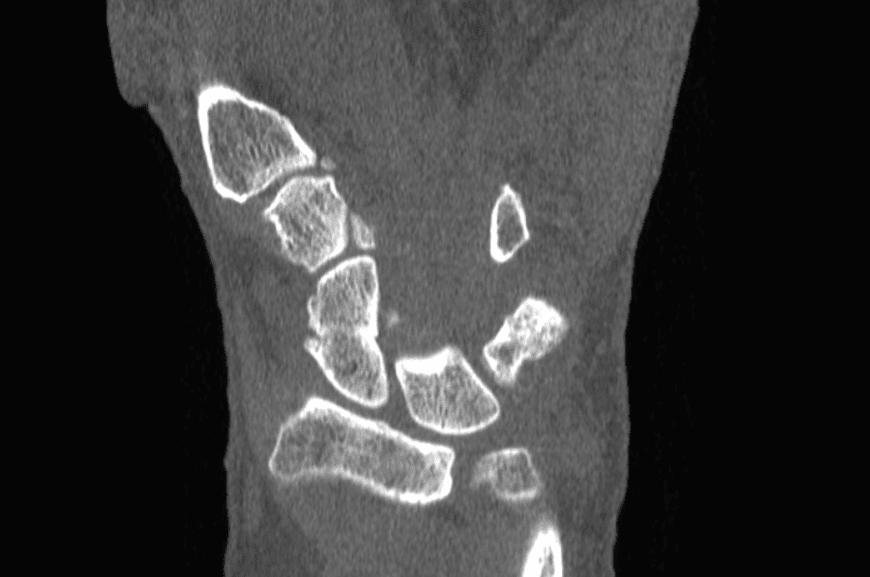 scaphoid fracture ct scan)