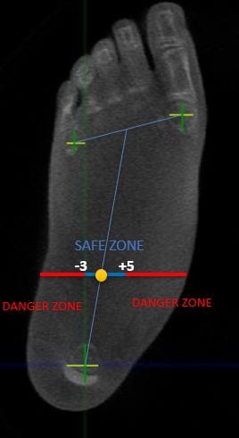 Courtesy of AOFAS. Researchers suggested the establishing a "safe zone" of ankle alignment to reduce the risk of peri-prosthetic cysts after total ankle replacement surgery.