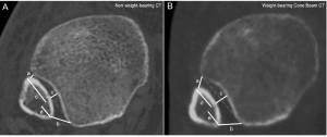 syndesmosis nwb vs wb