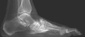 Charcot Lateral X-Ray