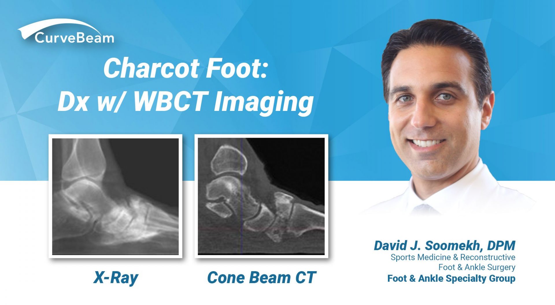 Charcot Foot: Dx w/ WBCT Imaging - CurveBeam