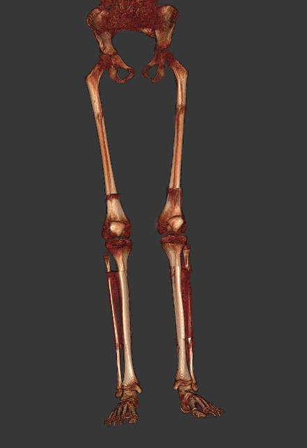 3D stacked full leg