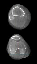 Patellar_Instability