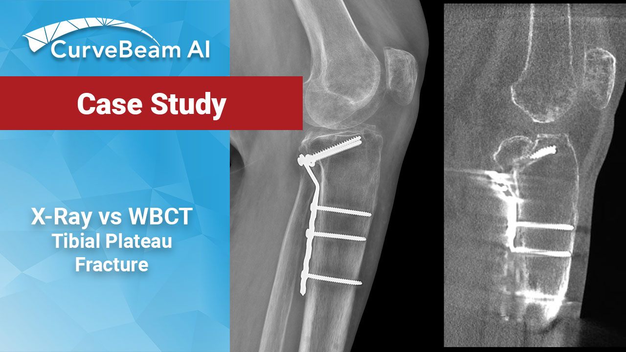 Tibial-Plateau-Fracture