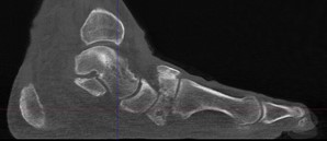 Charcot Lateral WBCT