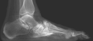 Charcot Lateral X-Ray