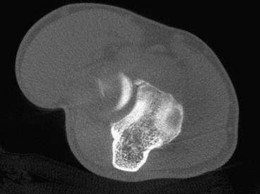 Coronoid Process Fracture