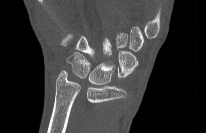 Scaphoid Fracture