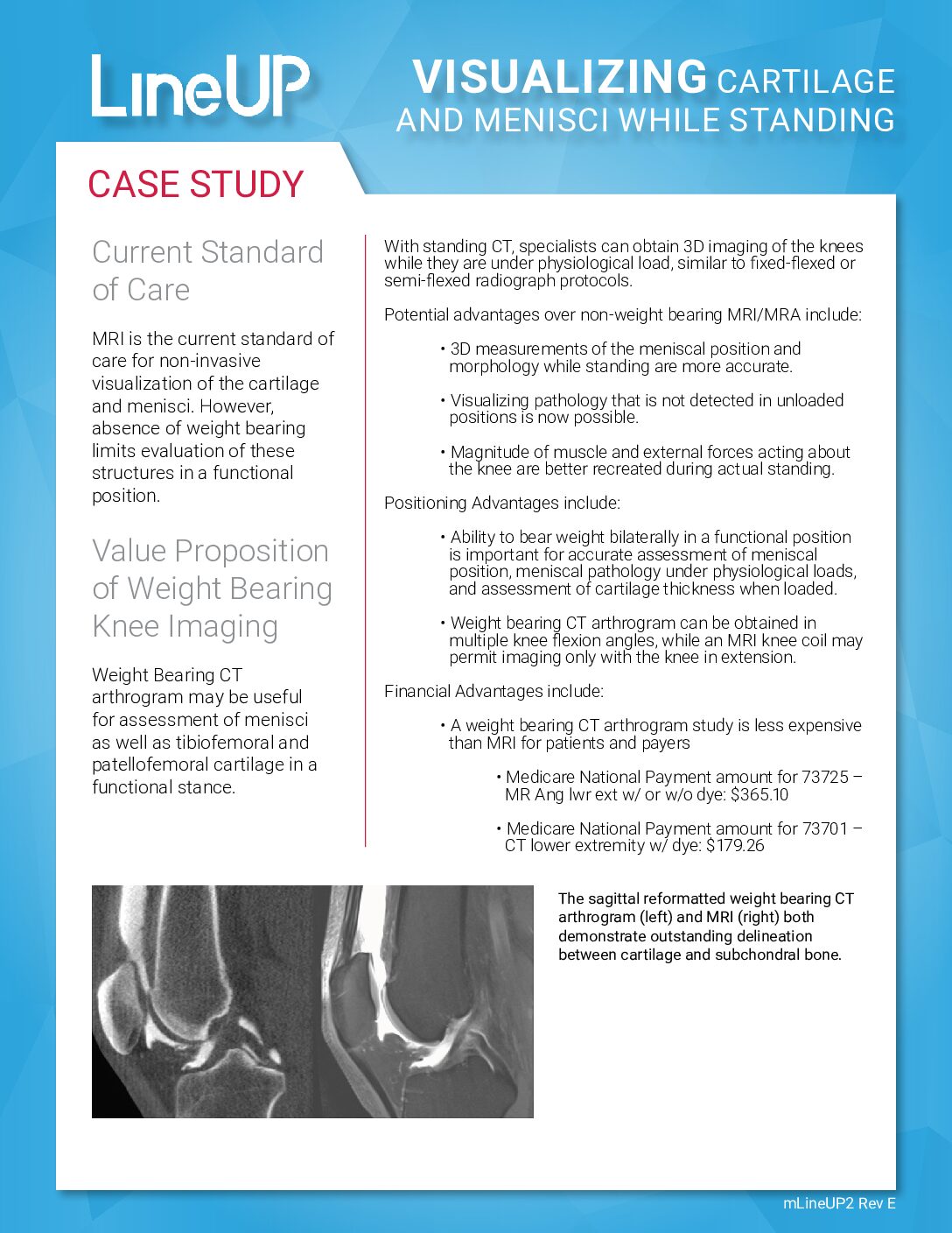 mLineUP2 Meniscus Case Study