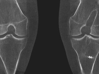 ACL Knee – tunnel – cor – bi-lat – slice