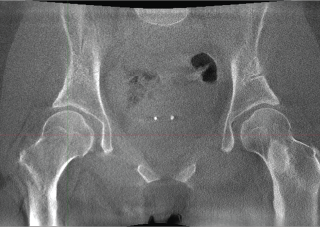 Hip Dysplasia – Cor – Slice