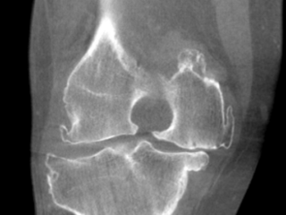 arthritic knee – cor – slice