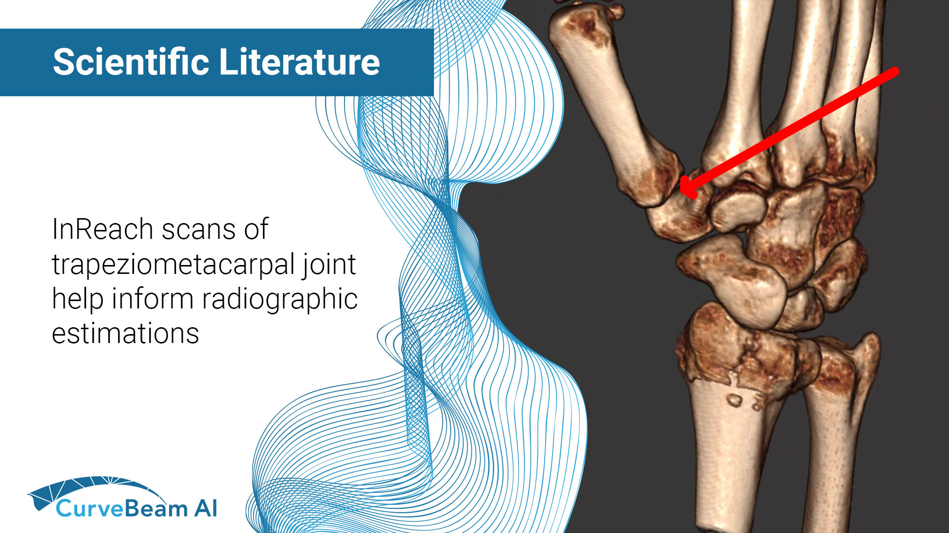 trapeziometacarpaljointwithCBCT