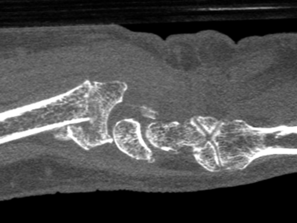 Distal Radius Fracture InReach – sag – slice – rotated