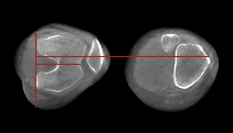 Patellar_Instability – rotated